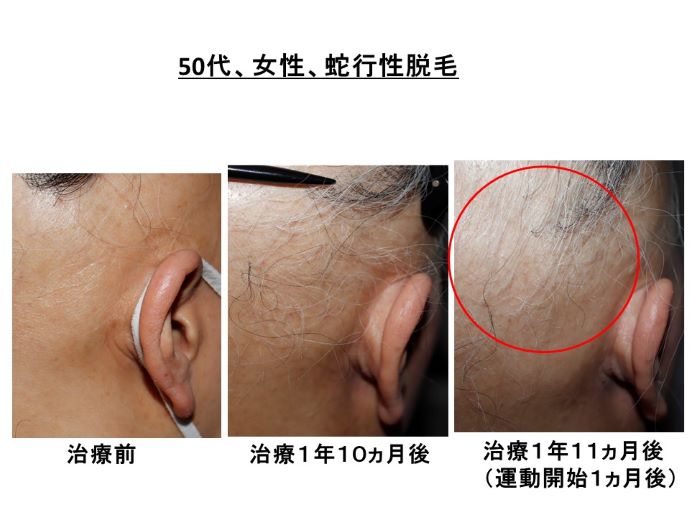 円形脱毛症　病院